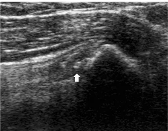 Fig. 4. In 8 months follow up, calcification nodule have changed into small calcific spot (yellow arrow).
