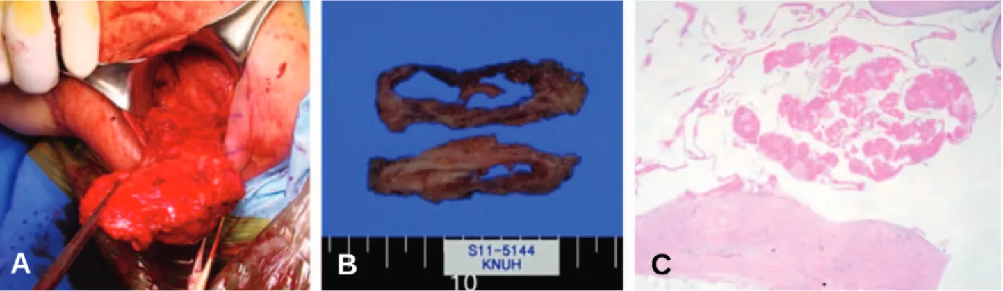 Fig. 2. MR images show well marginated cystic mass appeared hyperintense on T2 weighted images (A) and the wall was enhanced (B).