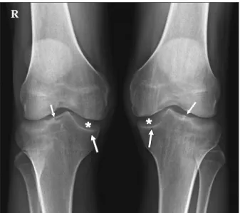 Figure 2. Magnetic resonance images. (A)  Right knee: coronal image shows discoid  medial  meniscus  with  horizontal  tear  (white arrow) and peripheral tear (asterisk)  on superior flap