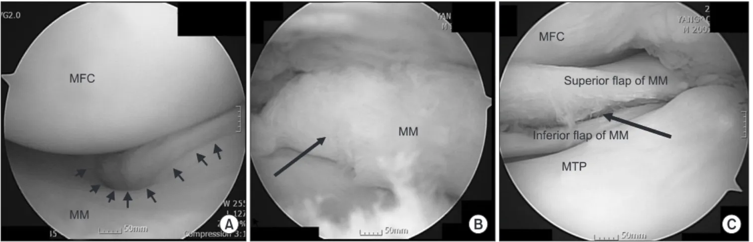 Figure 3. Arthroscopic findings. (A) Arthroscopic view shows complete discoid type of medial meniscus with peripheral tear (multiple arrows) of  right knee