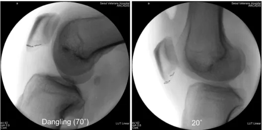 Fig. 2. Intraoperative C-arm images  demonstrating the relative positions of roll  wire (sutured to capsule) and the staple  (sutured to skin)