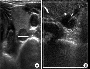 Fig. 4. Neck ultrasonogram. Multiple well-demarcated multiple  homogeneous hypoechoic mass are shown