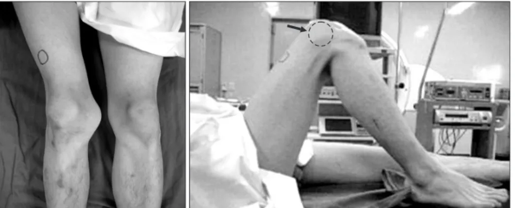 Fig. 2. (A) Two year after surgery, normal patella-femoral alignment was  achieved. (B) Distal femoral varus osteotomy was performed