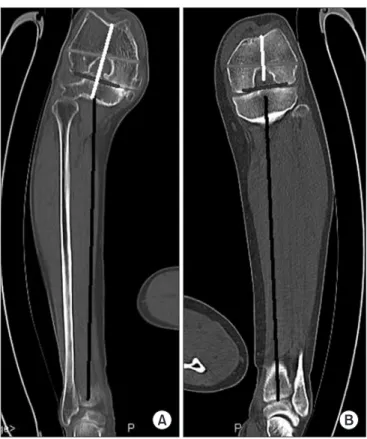 Fig. 2. (A) Femur cutting with 6.0 o  external rotation than posterior condylar line. (B) Femur cutting with 2.0 o  external rotation than Whiteside line.