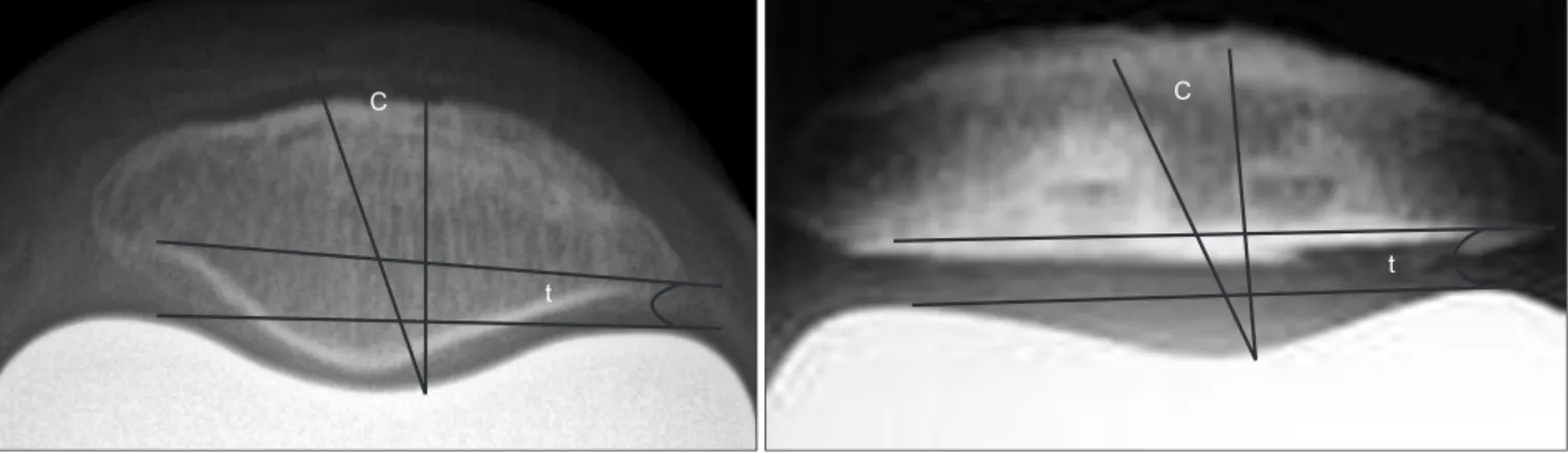 Fig. 3. Insall-Salvati ratio (A/B) is not  statistically different in the two groups.