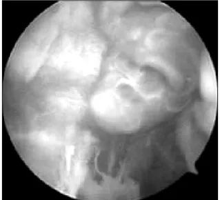 Fig. 8. Microscopic finding shows several proliferation  of  vascular channel with synovial lining (H&amp;E stain, ×40).
