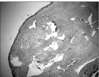 Fig. 9. Microscopic finding shows thin walled vascular space  of varying sizes lined with a single layer of endothelial cells  (H&amp;E stain, ×100).