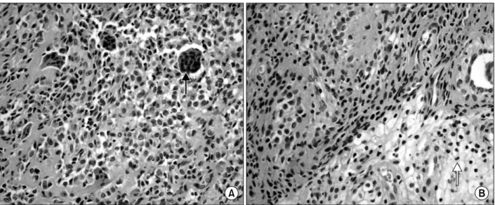 Fig. 3. Giant cell tumor of tendon sheath, localized type showing multinucleated giant cells (black arrow) admixed with round cells and collagen (H&amp;E, ×400) (A)