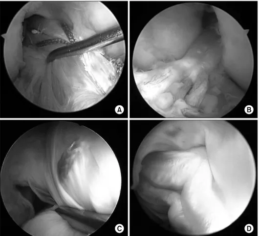 Fig. 1.  Arthroscopic  classifi- classifi-cation of grafts based on the  tension.  (A)  Taut   anterome-dial (AM) graft
