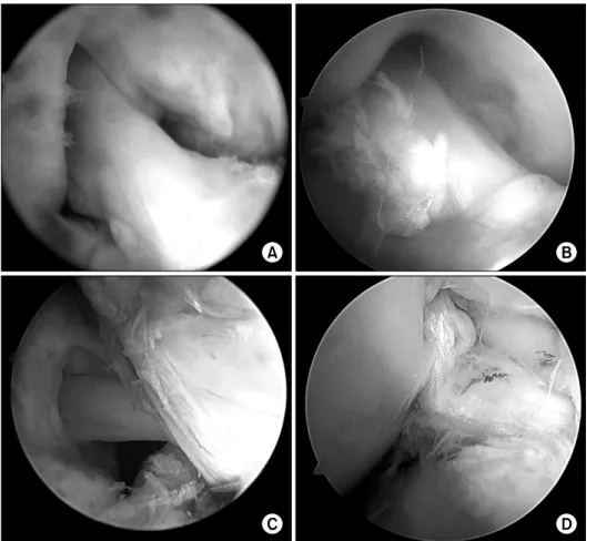 Fig. 2.  Arthroscopic  classifi- classifi-cation of grafts based on the  presence of rupture