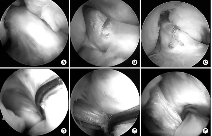 Fig. 3. Arthroscopic classification of grafts based on the synovial coverage. (A) Completely covered anteromedial (AM) graft is classified as “good.” (B) More than 50% covered AM graft is classified as “fair.” (C) Less than 50% covered AM graft is classifi