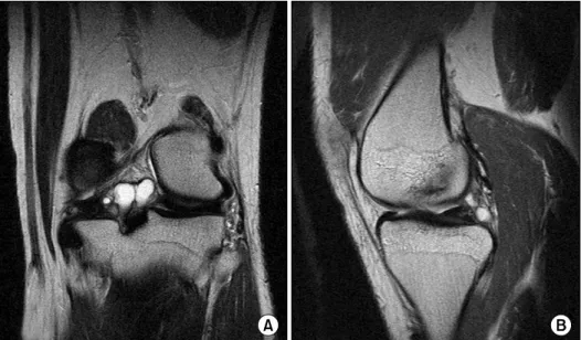 Fig. 3. MRI of the left knee  demonstrating  the  complete  discoid  medial  meniscus  with  posterior  cyst  formation