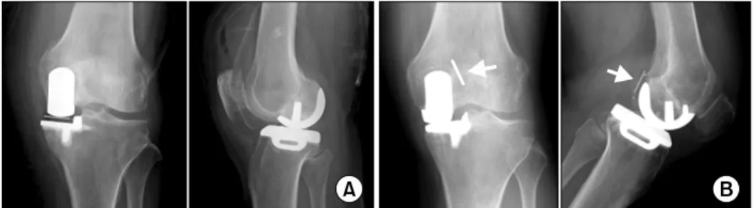 Fig. 3.  Complication of uni- uni-compartmental  knee   plasty. (A) Total knee  arthro-plasty  conversion  with   un-known origin pain in group 1