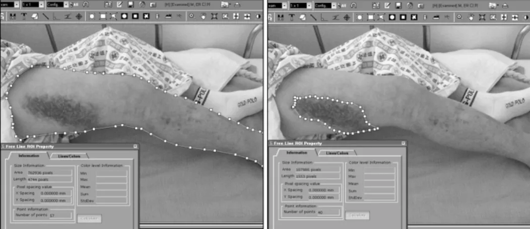 Fig. 1. Evaluation method for  subcutaneous bleeding. 대상  및  방법 1.  대상 　2010년 3월 4일부터 9월 16일까지 본원에서 인공 관절  전치환술을  시행한  129명의  환자를 대상으로  하였으며,  남자, 재치환술, 감염 등은 환자의 case가 적고 지혈대의  사용 시간이 길었으며 배액관을 사용하여 본 연구에서 제 외하였다