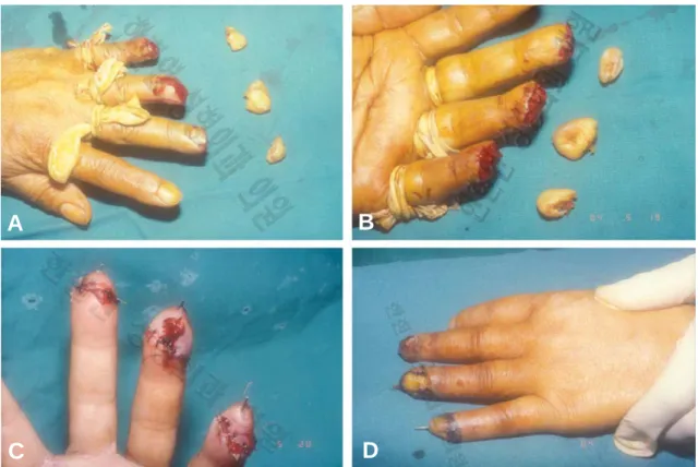 Fig. 1. Multiple Amputation of pulp of left 3,4 and little finger in a 55-year-old female, (A) Preoperative appearance (Dorsal view), (B) Preoperative appearance (Volar view), (C) Post operative 1 day good circulation without external bleeding, (D) Appeara