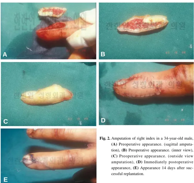 Fig. 2. Amputation of right index in a 34-year-old male, (A) Preoperative appearance. (sagittal  amputa-tion),  (B) Preoperative appearance
