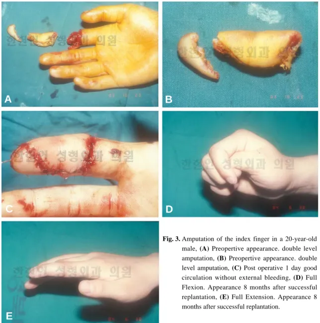 Fig. 3. Amputation of the index finger in a 20-year-old male,  (A)  Preopertive appearance