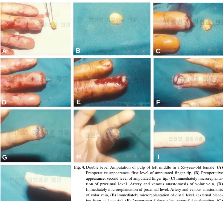 Fig. 4. Double level Amputation of pulp of left middle in a 55-year-old female, (A) Preoperative appearance