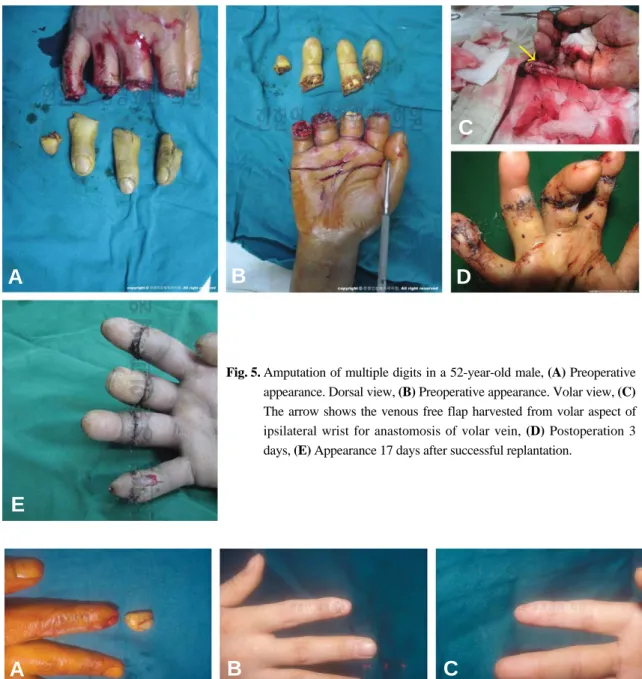 Fig. 5. Amputation of multiple digits in a 52-year-old male, (A) Preoperative appearance