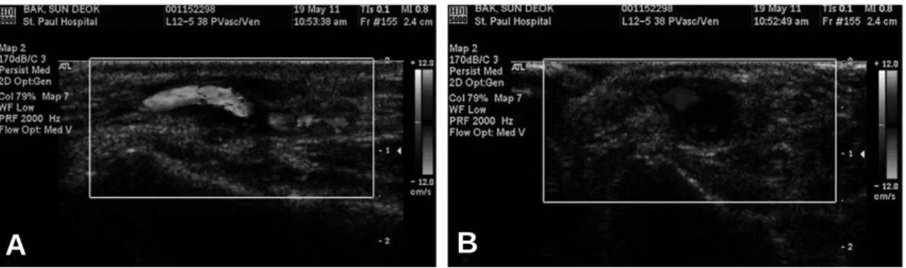 Fig. 2. Preoperative Doppler sonography showed ill-defined hypoechoic lesion adjacent to the radial artery