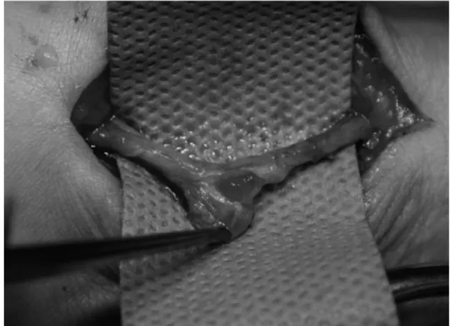Fig. 5. After cautious excision of adventitial cyst, the rem- rem-nant of adventitia from radial artery was seen.