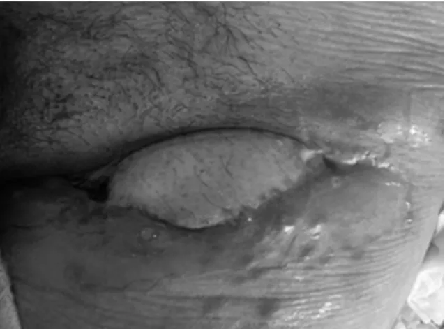 Fig. 2. Flap elevation and transferring under rectus femoris and subcutaneous tunnel.