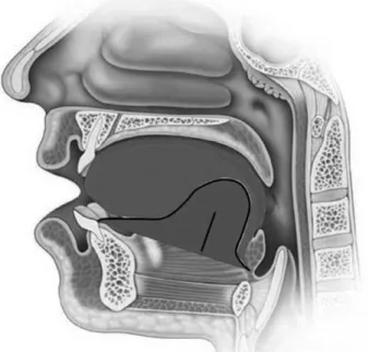 Fig. 1. Flap elevation and wedge shape deepithelization of both side.