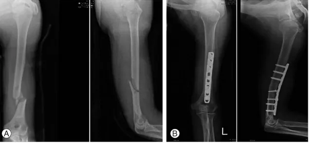 Fig. 1. (A) Initial anteroposterior and lateral radiographs of a 20-year-old male with spiral humeral distal shaft fracture