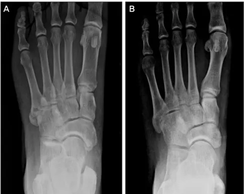 Figure 2. 68-year-old man with zone I fracture  of 5 th  Metatarsal bone. Initial foot A-P view  with comminuted fracture