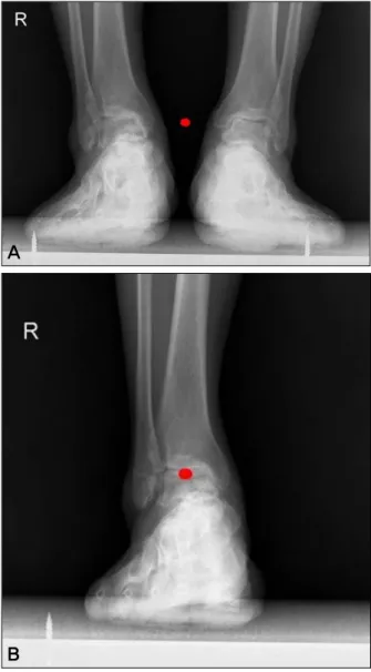 Figure 1. Weight bearing ankle standing anteroposterior view (Spot  is X-ray beam center)