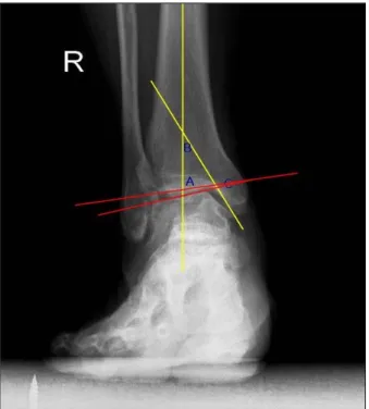 Figure 3. Radiologic assessment. (A) Maximum and minimun  perpendicular width between tibial plafond and talar dome