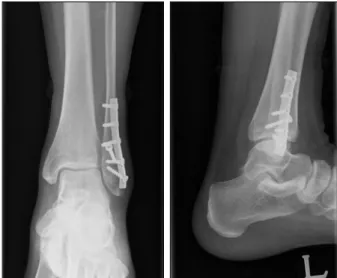 Figure 4. Postoperative radiograph shows lateral plate fixation and  interfragmentary screw.