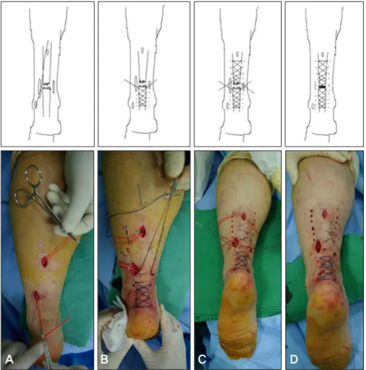 Figure 1. (A) Longitudinal incision is  made in the skin both just medial  and just lateral to the gap of the  ruptured tendon and sural nerve  isolation is done