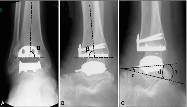 Figure 4. (A), (B) Post-operative radiographs showing the α angle defined as the angle between the anatomical axis of the  tibia and the articulating surface of the tibial component on AP radiograph and the β angle measured in the same way as  the  α angle