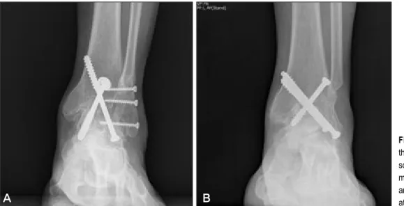 Figure 1. (A) An ankle ar- ar-throdesis was done using  screw fixation with  reattach-ment of distal fibula