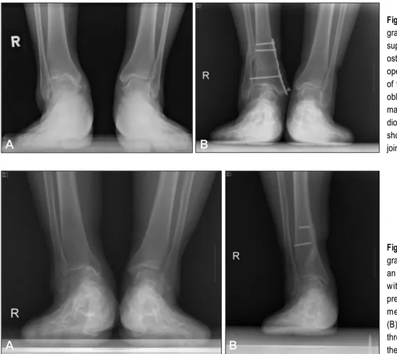 Figure 1. Anterior posterior radio- radio-graphs of the ankle which shows a  supramalleolar osteotomy including  osteotomy of the fibula