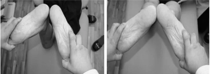 Fig 1. Dial test. Left ankle is externally rotated 10 degrees more than the other side in both 20 degrees and 90 degrees knee flexion.