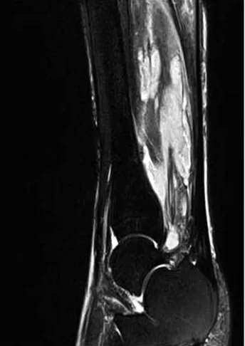 Fig. 1. 3-phase bone scan with Tc99 m shows increased blood flow and blood pool in the lower half of the left leg medially and later- later-ally