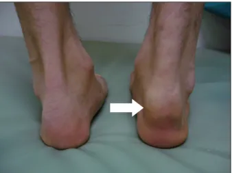 Figure 2. The preoperative  radiograph shows 5 cm  sized heterotropic  ossifica-tion located 1 cm above the  upper margin of calcaneal  tuberosity.