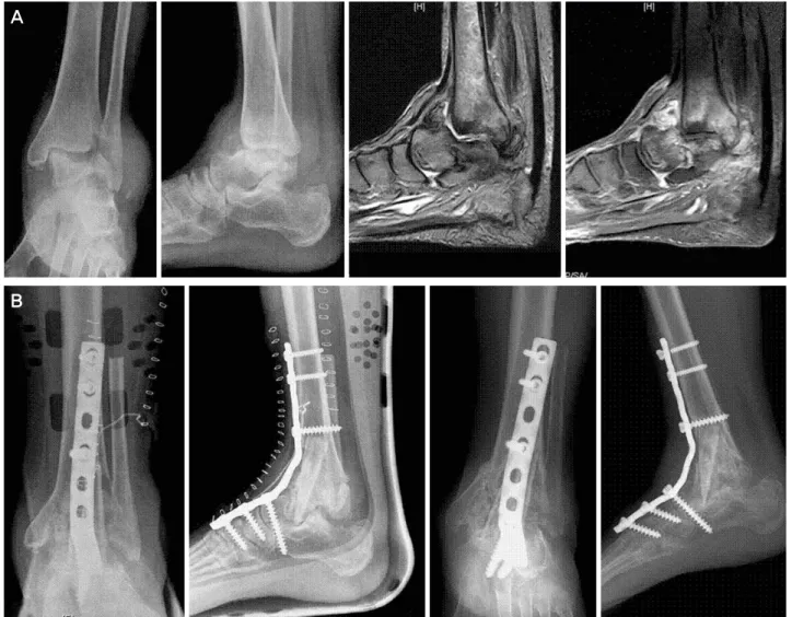 Figure 1. 55 years old female patient with osteonecrosis of talus. (A) Preoperative radiograph shows talar osteonecrosis with severe bone  destruction and collapse