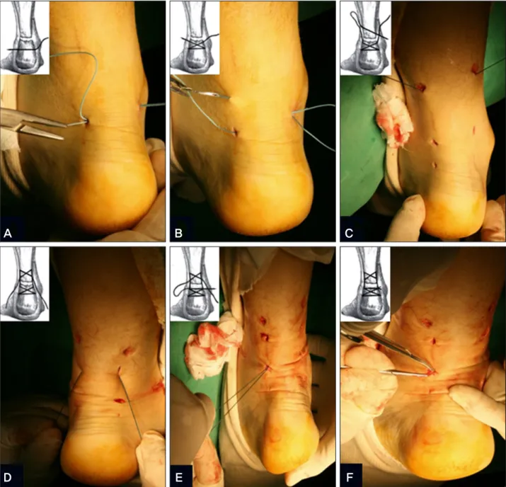 Figure 1. The procedure was started and finished medially and distally. First, a long needle was transversely passed through the tendon (A),  followed by a (diagonal) cross-suture (B)