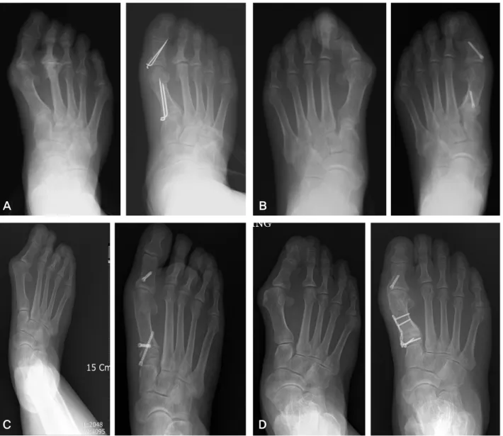 Figure 1. (A) Hallux valgus was corrected after proximal chevron osteotomy fixed with 2 k-wires
