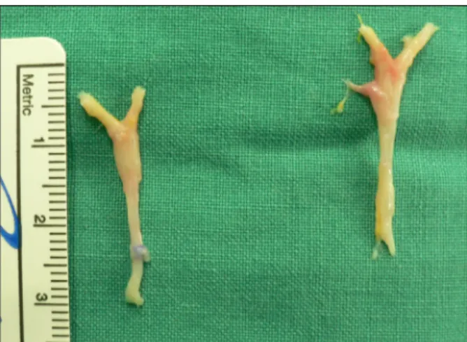 Figure 2.  Enlarged interdigital nerves were resected from both 2nd  (left side) and 3rd (right side) web spaces of Rt foot.