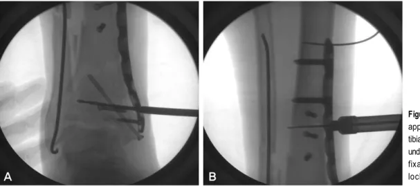 Figure 4. (A) Temporary  application of medial distal  tibia locking plate (Synthes ® ) under C-arm guided