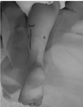 Figure 3. Dissection and splitting tendon  and subcutaneous fat tissue using smooth end dura elevator through the 0.5 cm  sized portal (A)