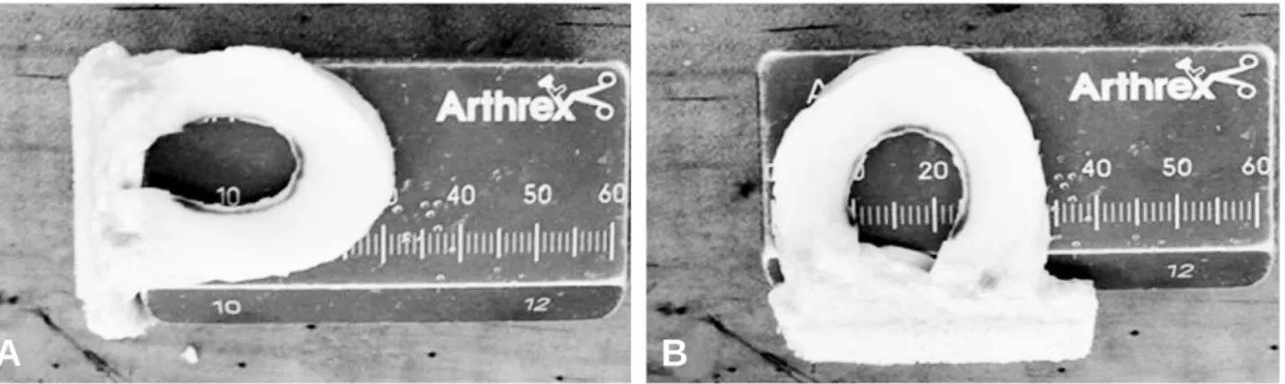 Fig. 1. Fresh-frozen meniscal allograft.