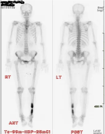 Figure 2. Two solitary lesion in the tibia shaft. Geographic osteolytic lesion, inner fat component were found