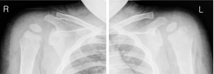 Fig. 1. Preoperative radiograph of right shoulder shows widening of the glenohumeral joint without any bony change.