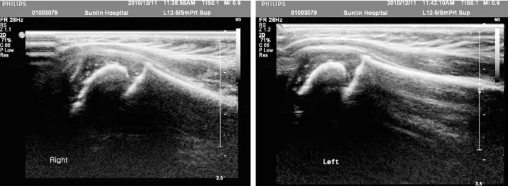 Fig. 5. Postoperative 14 months follow-up ultrasonogram of right shoulder shows no effusion in glenohumeral joint space compared with left shoulder.
