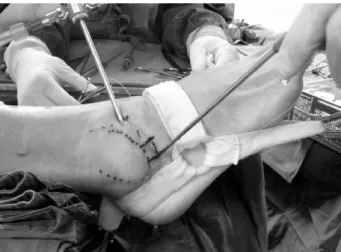Fig. 4. The fixed Fiberwire was retracted from outside portal with Birdbeak suture passer TM .